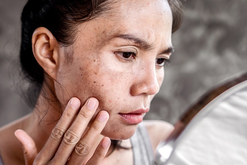 کاهش لک پوستی با ضدآفتاب